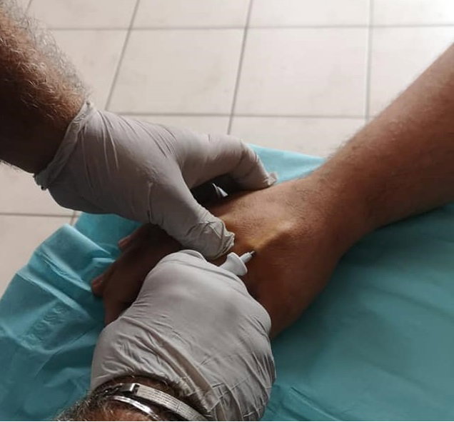 Un microbiglietto da visita sempre «a portata di mano»: parla un alessandrino col chip sottopelle